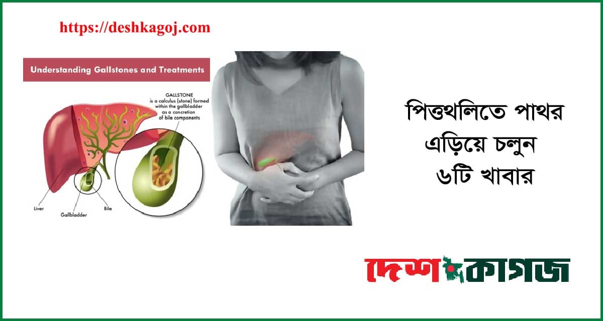পিত্তথলিতে পাথর
